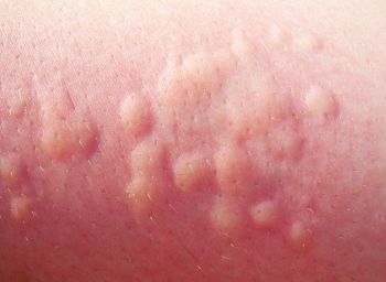 Allergiás bőrkiütés gyermekeknél néz ki, mint a képen, különféle allergiák a bőrön, tünetei és kezelése
