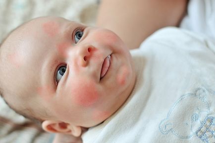 Allergia csecsemőknél okoz, típusai és kezelése