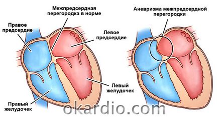 WFP aneurizma (pitvari septum) a felnőttek és gyermekek