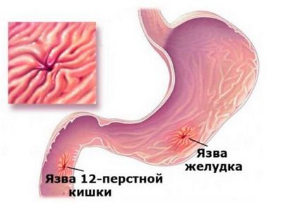 Antrum a gyomor - gastritis, fekélyek, polipok és más betegségek az antrum