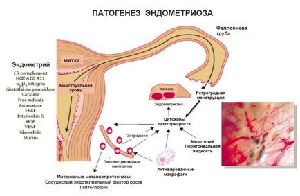 A veszélyes endometriózis 1