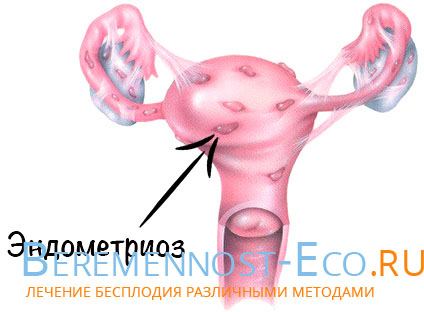 Mennyire veszélyes a méh endometriosis