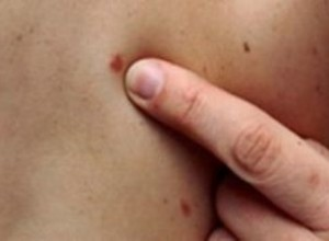 Mi a diszpláziás anyajegyet, típusai, okai, kezelése (vajon lehetséges-e, hogy távolítsa el a diszpláziás anyajegyet Surgitron) Mi a diszpláziás anyajegyet, típusok okai, kezelése