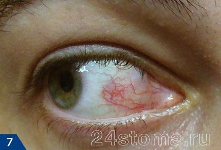 Herpesz a szemet - fotók, hatékony terápia a komplikációk elkerülése érdekében