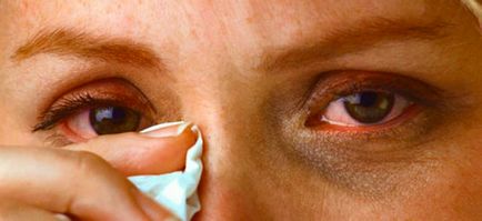 Herpes szem (ophthalmoherpes) - tünetei, kezelése, fotók
