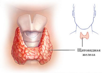 Pajzsmirigyműködés egy pajzsmirigy - mit okoz, tünetei és kezelések