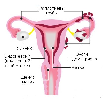 hirudotherapy endometriózis