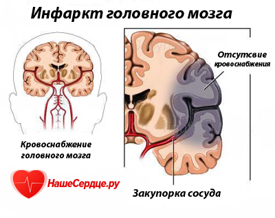 agyi infarktus okoz, Effects és kezelés