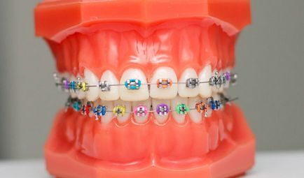 Mi jobb, hogy a felnőtt fogszabályozó összehangolni a fogak és harapás