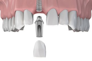 Mi jobb, ha koronák implantátumokra, felülvizsgálatát árak és értékelés (implantátumok) Mi jobb, ha koronák implantátumokra, felülvizsgálatát árak és vélemények