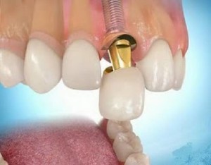Mi jobb, ha koronák implantátumokra, felülvizsgálatát árak és értékelés (koronák implantátumokra) Mi jobb, ha koronák implantátumokra, felülvizsgálatát árak és vélemények