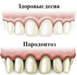 Hogyan kell kezelni a fogágy az otthoni népi jogorvoslati 1