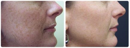 Hogyan megfiatalítani arcbőr kezelés, lézeres visszatérő, kémiai hámlasztás