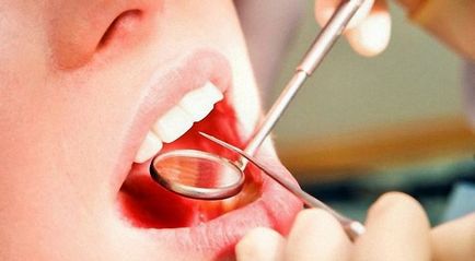 Hogyan lehet eltávolítani a fogkövet otthon (eltávolítás) Hogyan lehet eltávolítani a fogkövet otthon