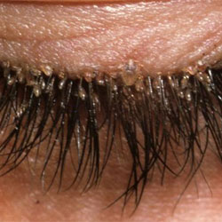 Demodikózis kezelésére szeme -, hogyan lehet megszabadulni a kullancs a szemhéj és szempillák
