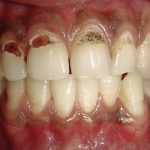 A kezelés a fogszuvasodás felnőtteknél, okai és tünetei megjelenése