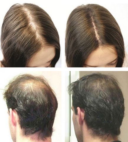 Bow hajhullás nőknél és férfiaknál felülvizsgálat receptek, a hatékonyság, előtt és után
