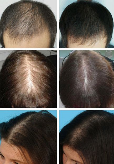 Bow hajhullás nőknél és férfiaknál felülvizsgálat receptek, a hatékonyság, előtt és után
