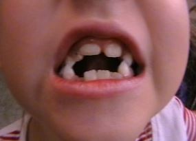 Miogimnastika fogszabályozási