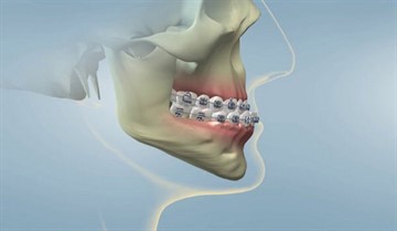 Overbite (az alsó állkapocs mozgatása előre) rögzíti segítségével ortopédiai rendszerek (malocclusion az alsó állkapocs előre korrekció) Overbite (az alsó állkapocs mozgatása előre) rögzíti segítségével ortopédiai rendszerek és