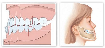 Overbite (az alsó állkapocs mozgatása előre) rögzíti segítségével ortopédiai rendszerek és (harapás) Overbite (az alsó állkapocs mozgatása előre) rögzíti segítségével ortopédiai rendszerek és