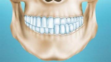 Overbite (az alsó állkapocs mozgatása előre) rögzíti segítségével ortopédiai rendszerek (hibás) Overbite (az alsó állkapocs mozgatása előre) rögzíti segítségével ortopédiai rendszerek és