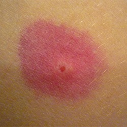 Bőrpír és duzzanat rovarcsípés után a tünetek, a kezelés és a megelőzés