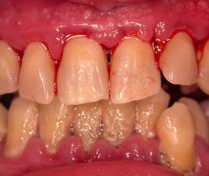 A periodontitis tünetei és kezelése otthon