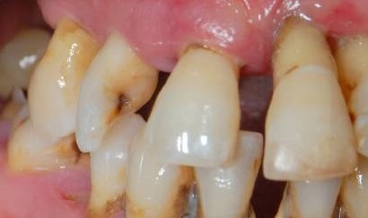 A periodontális betegség kép, tünetei és kezelése otthon
