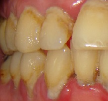 A periodontális betegség kép, tünetei és kezelése otthon
