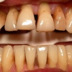 A periodontális betegség tünetei, okok, kezelés