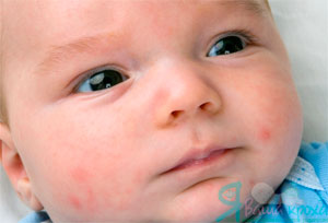 Élelmiszer allergia csecsemők (egy év), a tünetek, a kezelés és tanácsadás