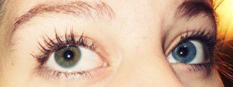 Miért különböző színű szemek okai heterochromia