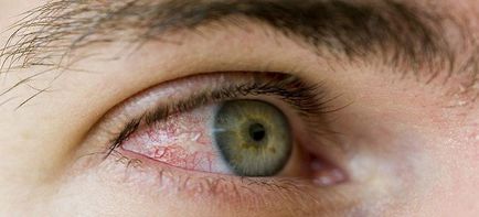 Bőrpír a szemét - Okok és kezelés