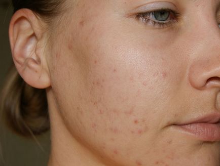 Bőrpír után pattanások - hogyan lehet megszabadulni az arc, domborított, otthon (acne) Bőrpír után pattanások - hogyan lehet megszabadulni az arc, domborított, otthon