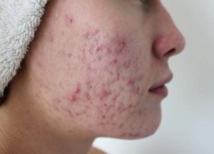 Okai gennyes pattanások az arcon és kezelésük