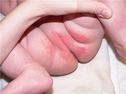 Megelőzése és kezelése pelenkakiütés csecsemők népi módon kenőcsök listája