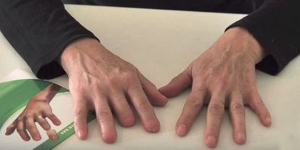 Az ortopéd ujjak - kéz- és lábujjak