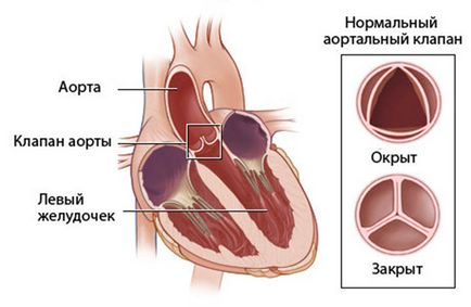 Az aortabillentyű visszaáramlás 1 fok az a veszély, és hogyan kell kezelni