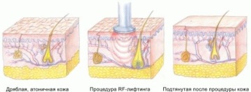 Rf-felhajtótest mi ez, és hogyan lehet a bőr rugalmasságát és feszes
