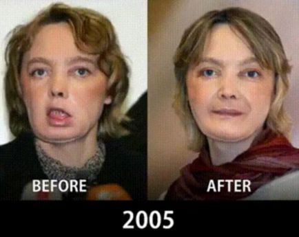 Összehasonlító ábrázoló fényképeket, hogyan arcátültetést jöttek 10 éves, umkra