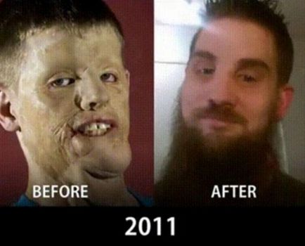Összehasonlító ábrázoló fényképeket, hogyan arcátültetést jöttek 10 éves, umkra
