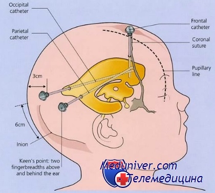 Technika ventriculoperitoneal tolatási hydrocephalus (hydrocephalus) Technika ventriculoperitoneal tolatási hydrocephalus