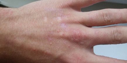 Hólyagok az ujjak - mi okozza a vizes bőrkiütések és kezelés