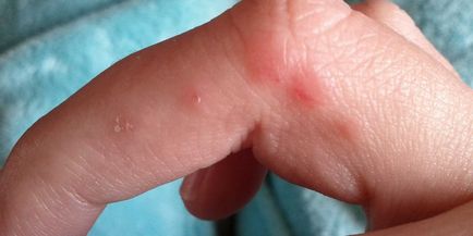 Hólyagok az ujjak - mi okozza a vizes bőrkiütések és kezelés