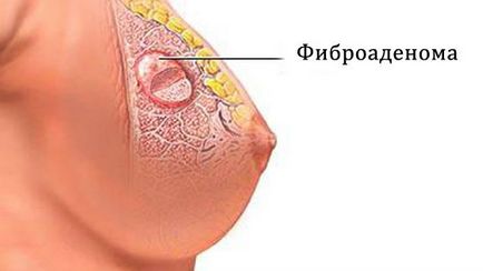Fibroadenomatosis emlő kezelésére Fibroadenomatosis emlő kezelésére
