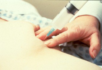 Fibroadenomatosis emlő kezelésére Fibroadenomatosis emlő kezelésére