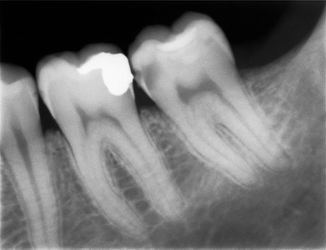 szuvasodás a dentin