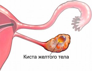 Miért vannak kialakítva ciszták Miért vannak kialakítva ciszták