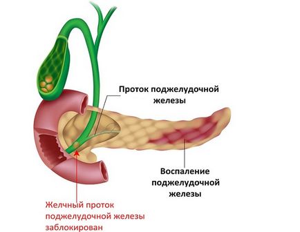 Mi pancreatitis a hasnyálmirigy